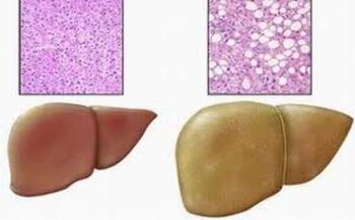 Gan nhiễm mỡ làm sao tránh được?
